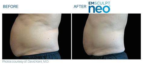 Emsculpt NEO Body Sculpting Grace Gynecology Wellness