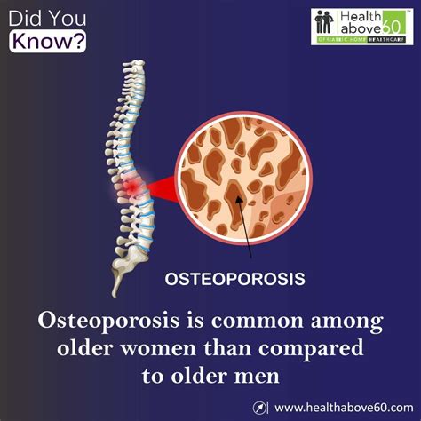 Osteoporosis Causes Prevention Gwc Radiology Hot Sex Picture