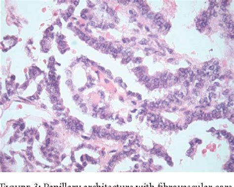 Figure 1 From A Case Of Papillary Thyroid Carcinoma In Struma Ovarii