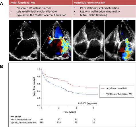 Prognostic Comparison Of Atrial And Ventricular Functional Mitral