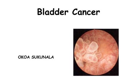 Bladder Cancer Risk Factors Pathophysiology And Treatment Ppt Free Download