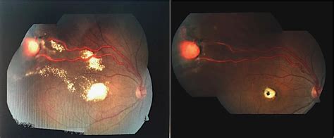 Figure 1 From Case Series Of Retinal Capillary Hemangioma In Patients With And Without Von