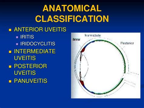 Uveitis Classification