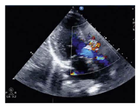 A Parasternal Long Axis 2d Echocardiographic Image Of A 13 Year Old