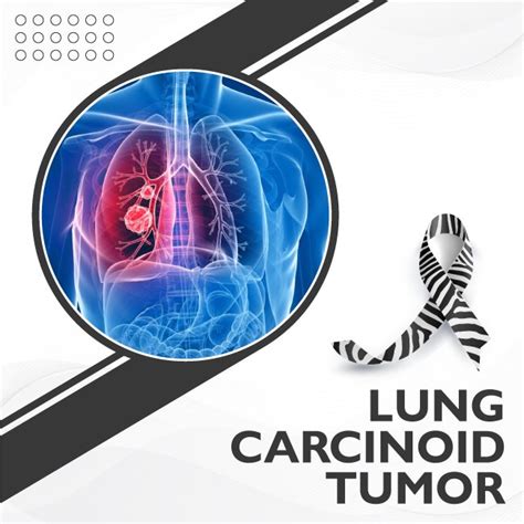 Lung Carcinoid Tumor, Signs and Symptoms | Uhapo