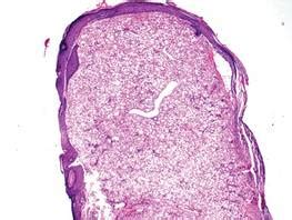 Clear Cell Fibrous Papule | MDedge Dermatology