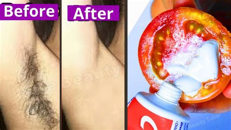 In Minutes Remove Unwanted Armpit Hair Permanently At Home