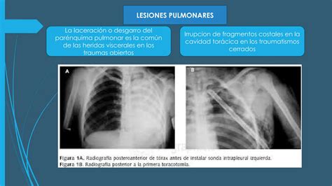 Traumatismo De Torax Y Sus Complicaciones Pptx