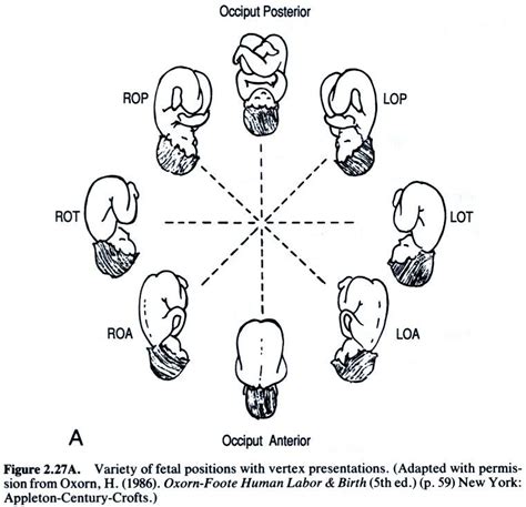 Fetal Position Nursing Info Labor Nurse Midwife Assistant Y