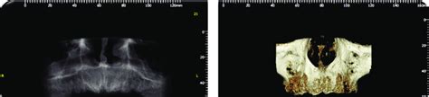 Diagnostic Preoperative Cone Beam Computerized Tomography Cbct