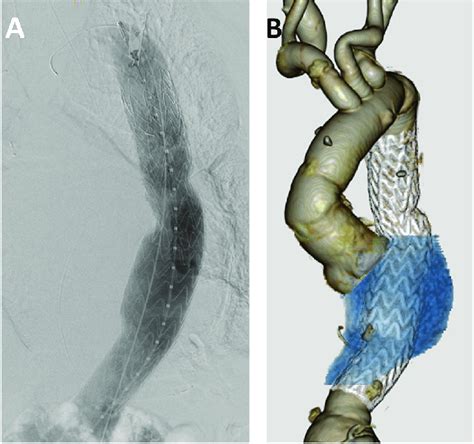 Postoperative Digital Subtraction Angiography A And Enhanced Computed