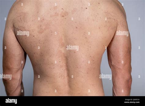 tinea versicolor sur le dos pityriasis versicolor problème avec la