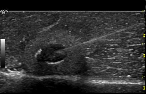 CP Advanced Imaging | Thyroid Biopsy