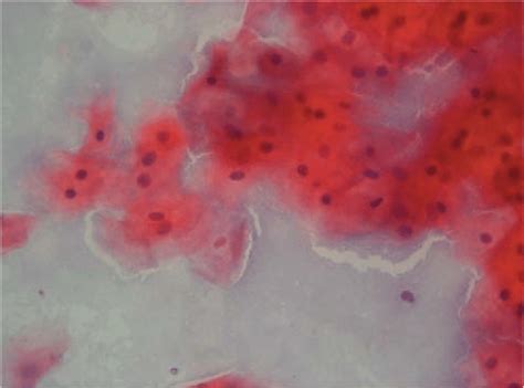 An Example Of A Pap Smear Clue Cells Covered By Bacteria Together