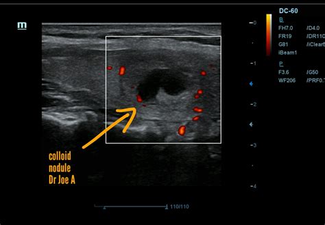 Ultrasound imaging: Colloid-nodules-thyroid