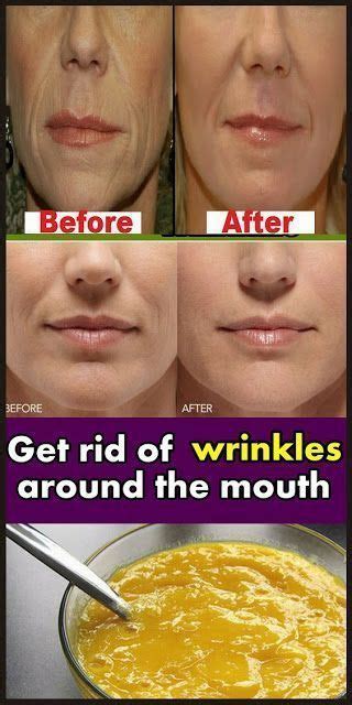 How To Remove Deep Mouth Wrinkles Really Fast Artofit