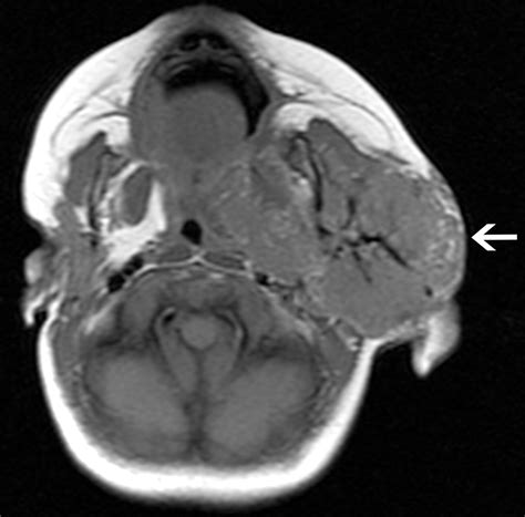 Congenital Oral Masses An Anatomic Approach To Diagnosis Radiographics