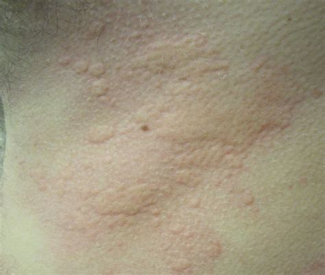 What are the Amoxicillin Allergy Symptoms and rash on the Skin? - Flash ...