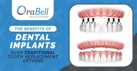 Do I Qualify For Dental Implants In The San Fernando Valley OraBell