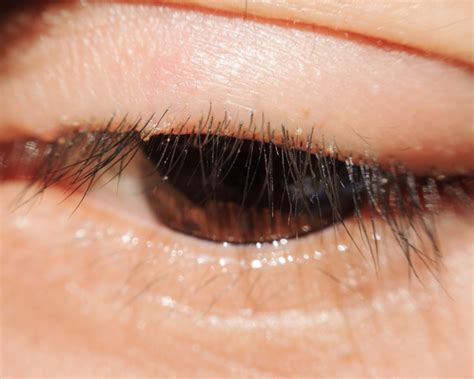 About Blepharitis Optase