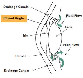 Glaucoma Symptoms, Diagnosis & Treatment | Capitol Eye Care