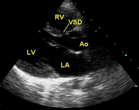 Echocardiographic profile in ventricular septal defect – video – All ...