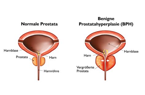 Urologie Neuwied Walters T Fomuki