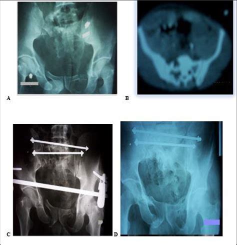 Posterior Sacral Bars Parallelogram And The Anterior Iliac Or Download Scientific Diagram