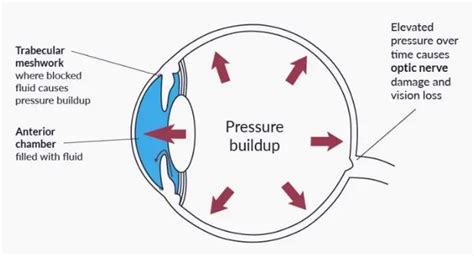 Feeling Pressure Behind Left Eye Causes Symptoms And Treatments An Eye Care Blog