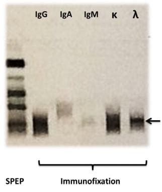 Immunofixation Serum Interpretation Mm