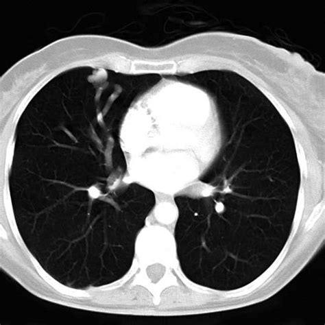 CT Pulmonary Angiogram Lung Windowed Image Of The Chest Demonstrating