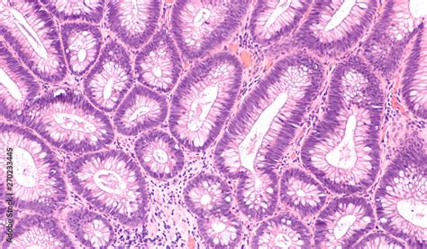 Microscopic (histology) of tubular adenoma. Adenomas are premalignant ...