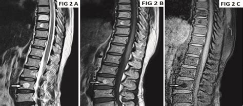 Hemangioma Mri