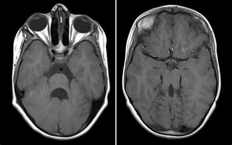 Dandy Walker Syndrome: Symptoms, Causes, Treatments