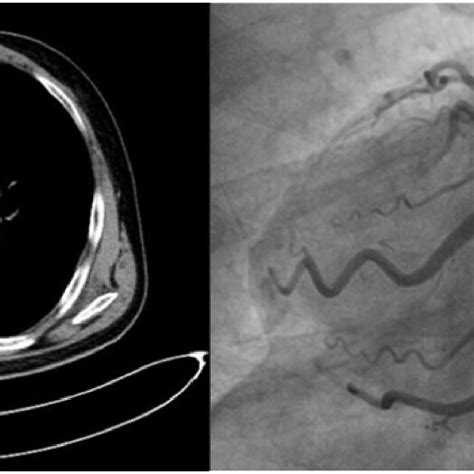 A Multidetector Computed Tomography Angiography Revealed An Ascending