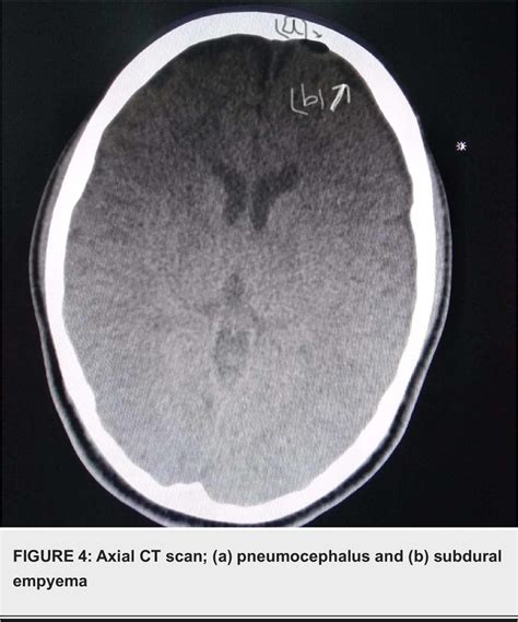 Figure From Non Traumatic Pneumocephalus And Sub Dural Empyema As A