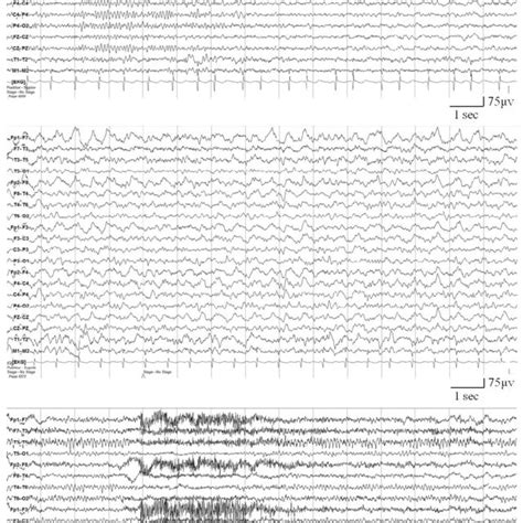 Electroencephalography (EEG) findings. | Download Scientific Diagram