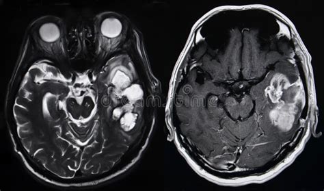 Tumor Cerebral Imagem De Stock Imagem De C Ncer Parietal