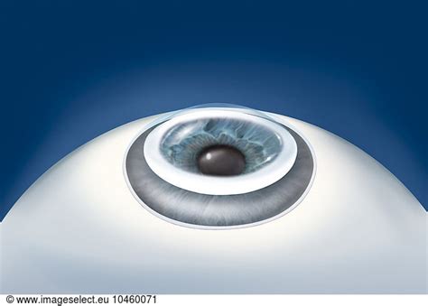 CORNEAL TRANSPLANT CORNEAL TRANSPLANT DRAWING Anatomy Eye Eyeball