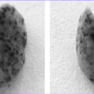 Macroscopic appearance of subpleural metastatic nodules. | Download ...