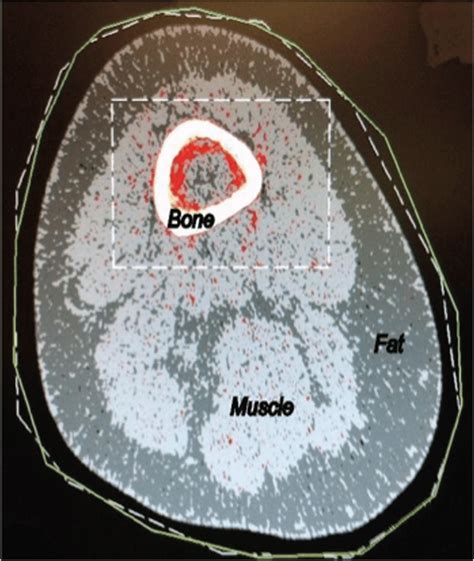 Representative Peripheral Quantitative Computed Tomography Scan Of The