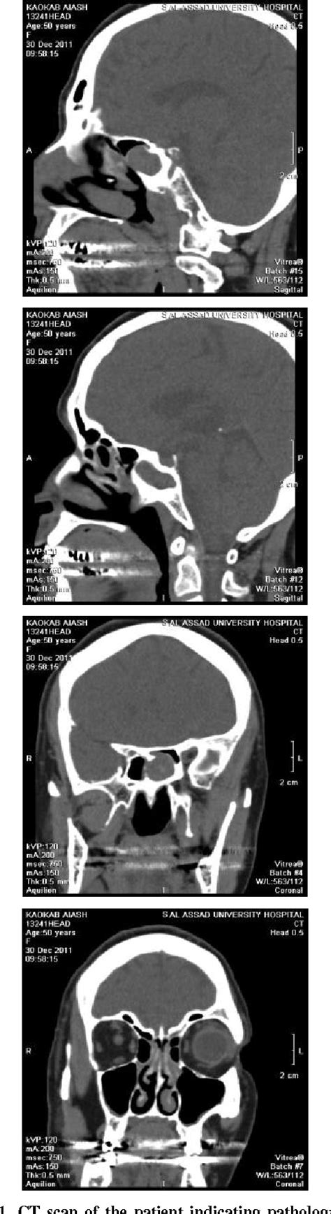 Figure 1 From Solitary Fungus Ball Of The Sphenoid Sinus Semantic Scholar