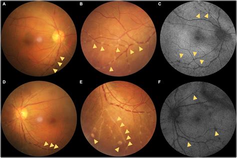 Frontiers Case Report A Rare Appearance Of Preretinal Deposits In A