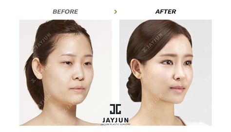 The Best Plastic Surgery In Korea Korean Star Plastic Surgery Korean