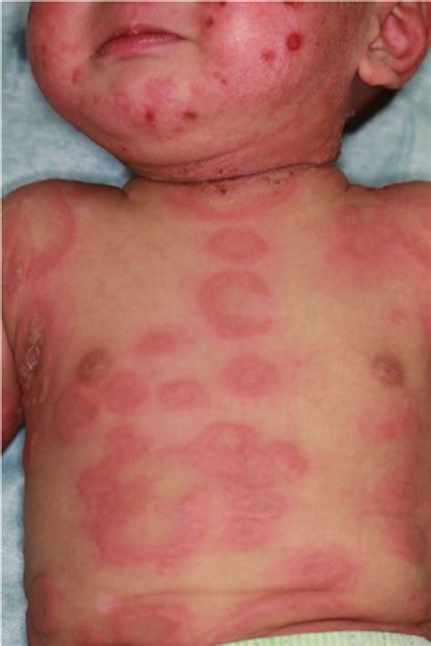 A Clinical Finding Of Extensive Annular Plaques With Blisters And