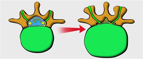 Discopathie Lombaire Chirurgie Rachidienne