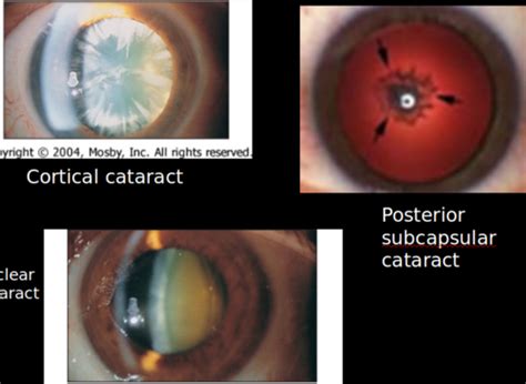 Posterior Subcapsular Cataract