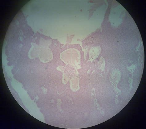 Basal Cell Carcinoma – howMed