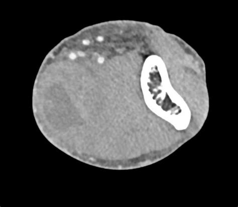 Abscess In Antecubital Fossa In A Drug Addict Musculoskeletal Case