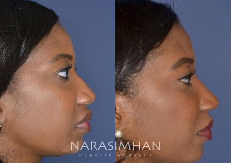 Rhinoplasty Before And After Women